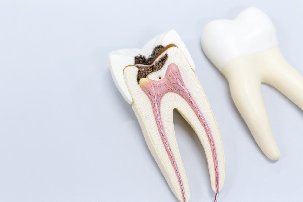 Ein entzündeter Zahn mit Wurzelkanal