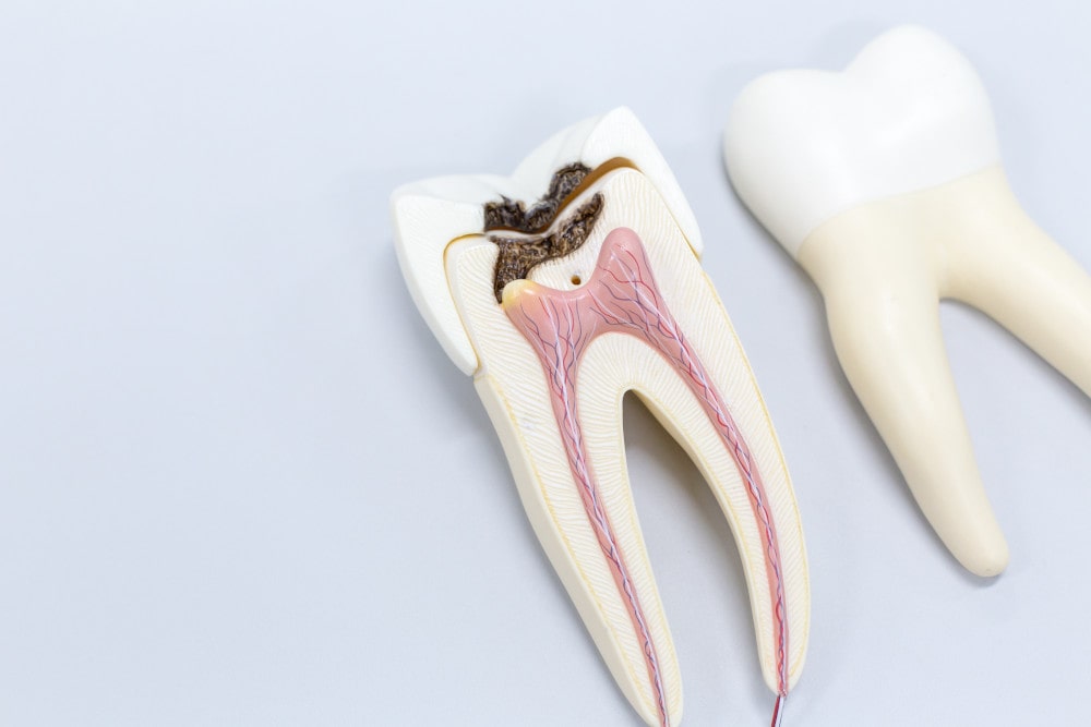 Endodontie Zahnarzt Stuttgart Ein entzündeter Zahn mit Wurzelkanal