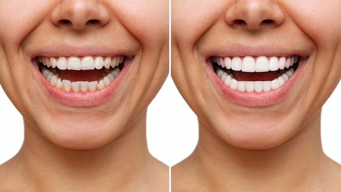 Veneers_Vorher_Nachher_Zahnarzt_Vaihingen_Wenninger-min Vorher Nachher Resultate bei Veneers