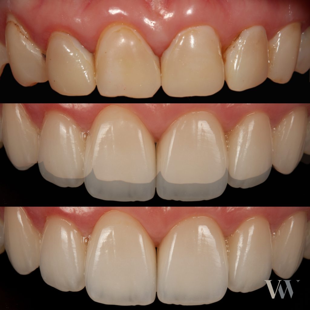 Darstellung Veneers Vorher/Nachher Veneers im Vergleich Vorher/Nachher